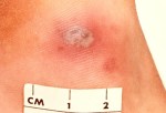 cellulitis