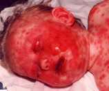 Stevens johnson syndrome
