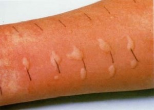 Positive skin tests look like this....