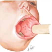 koplik illustration