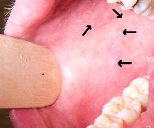 Kopliks spots for measles