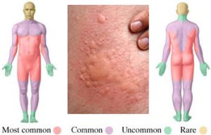 Common locations of hives