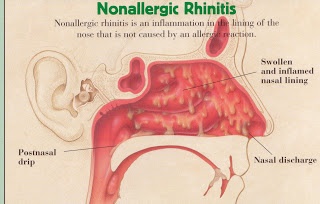 Mild Rhinitis I Can’t Get My Allergist to Diagnose Allergy! – TulsaAllergyNews